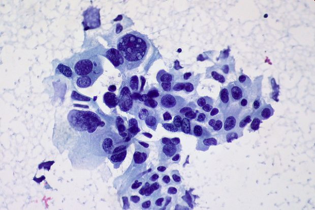 Foto:  Non-small Cell Carcinoma of the Lung, FNA, Ed Uthman, Flickr, CC BY-SA 2.0