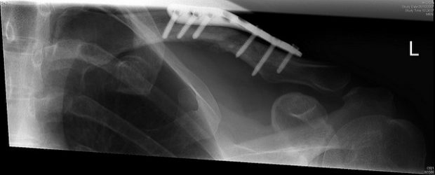 Implantate aus Titan unterstützen aktuell die Heilung von Knochenbrüchen. Foto:  How would I summarise 2007?, Oisin Mulvihill, Flickr, CC BY-SA 2.0